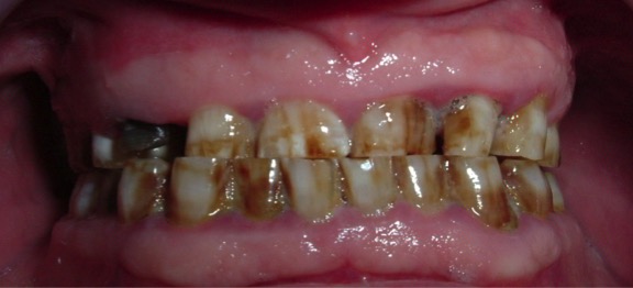 implantes dentales ultimos avances